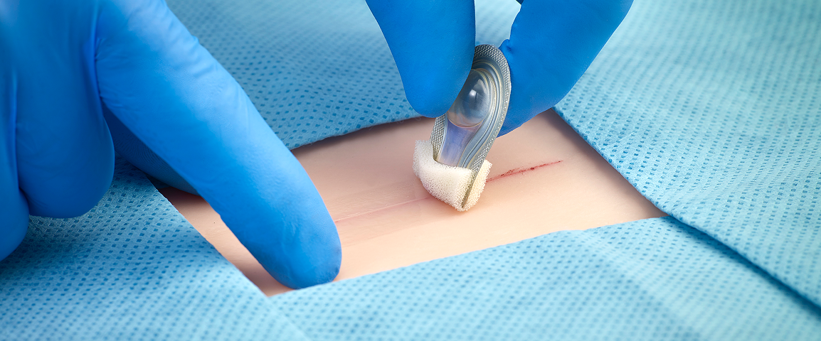 Closing the gaps for wound closure